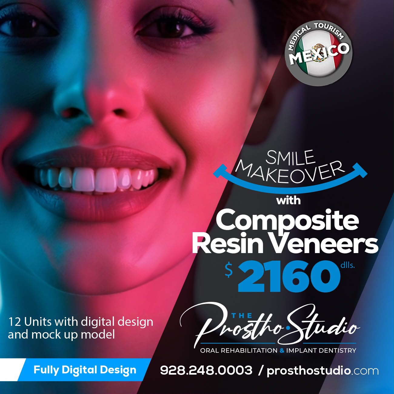 Smile Makeover Composite Resin Veneers 