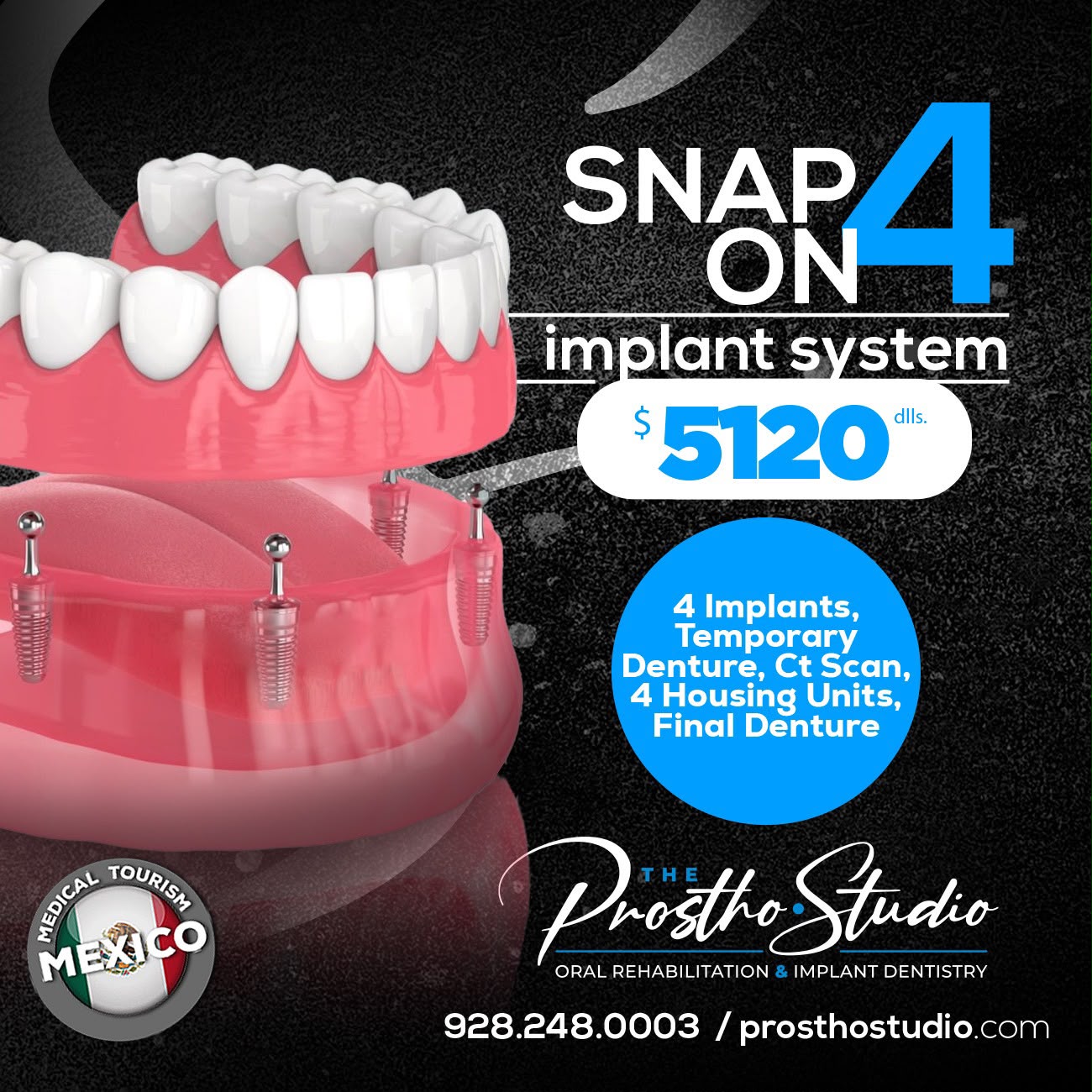 Snap On System 4 Implant Denture