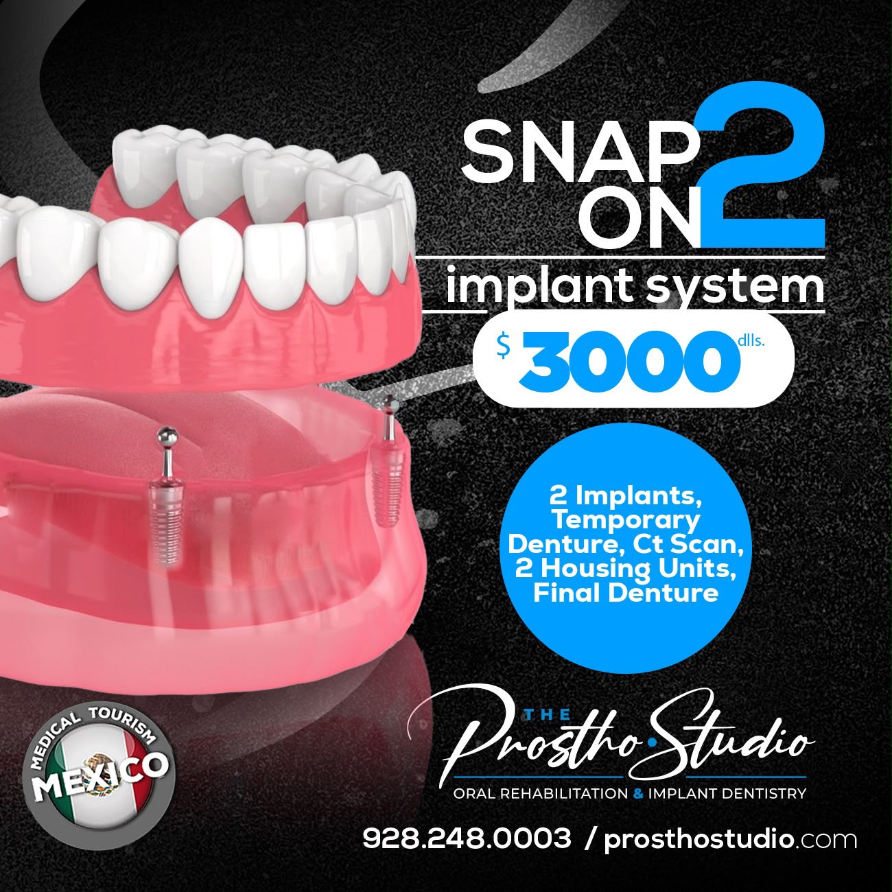 Snap On System 2 Implant Denture