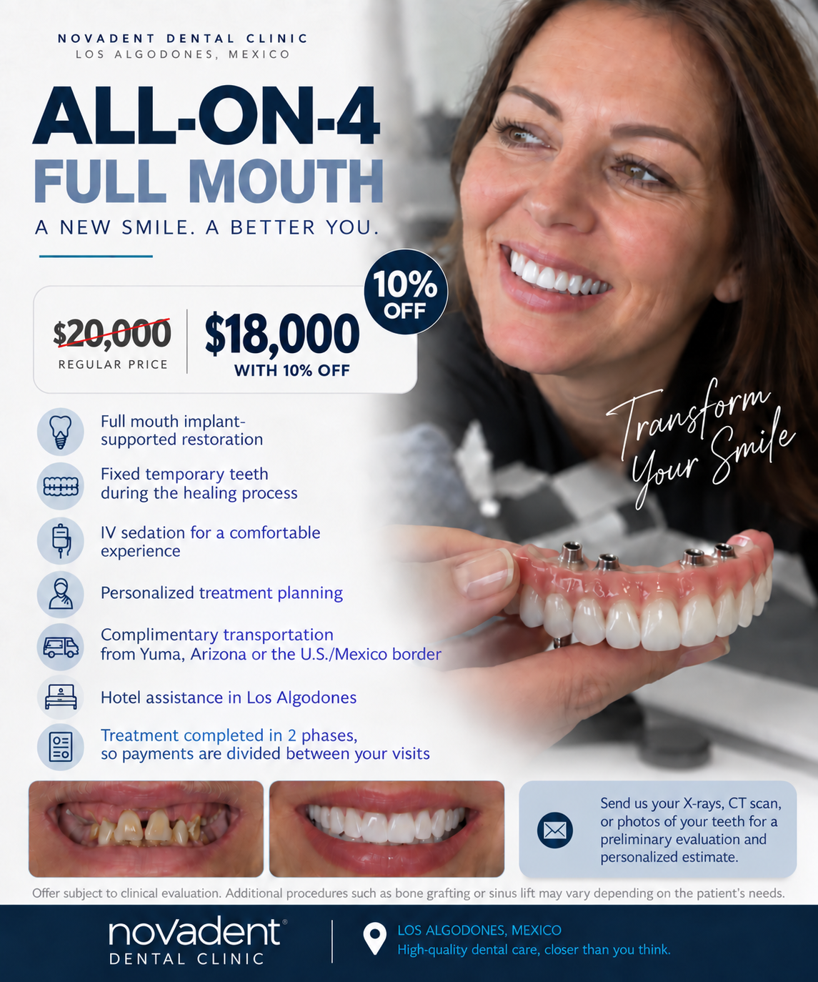 FULL MOUTH ALL-ON-4 SPECIAL – 10% OFF!