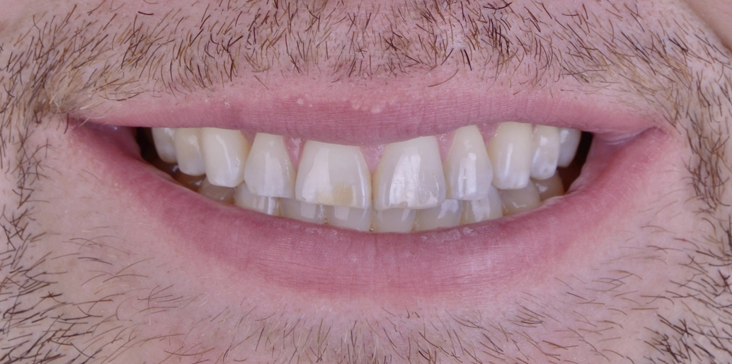 Before