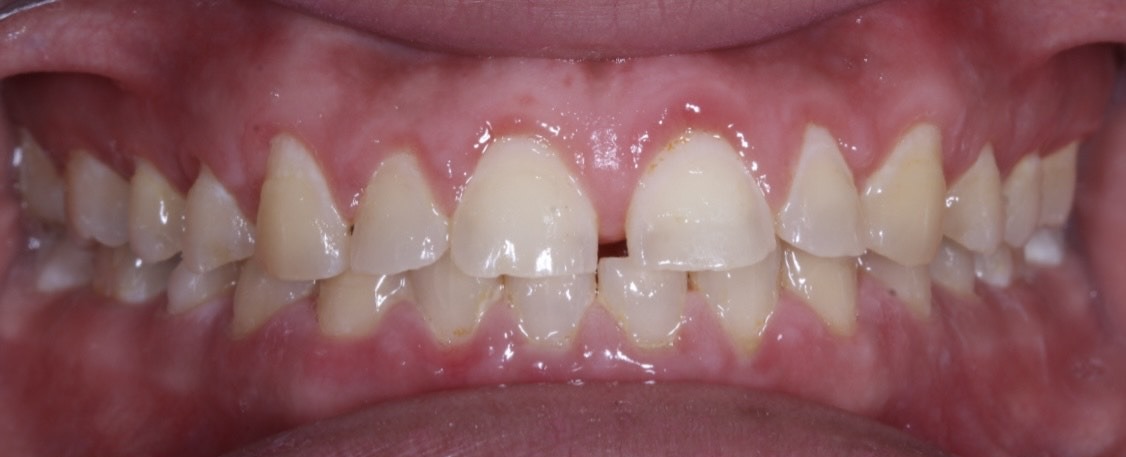 Before